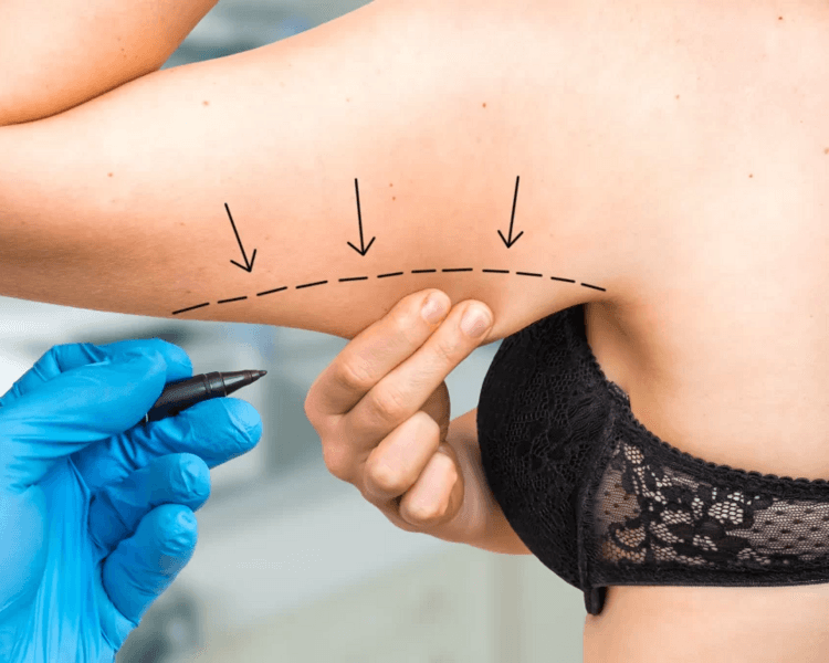 HIDROLIPOCLASIA QUEMADORES - BRAZOS