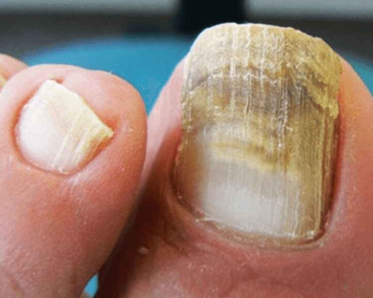 Acripie Medicado + Color en Gel