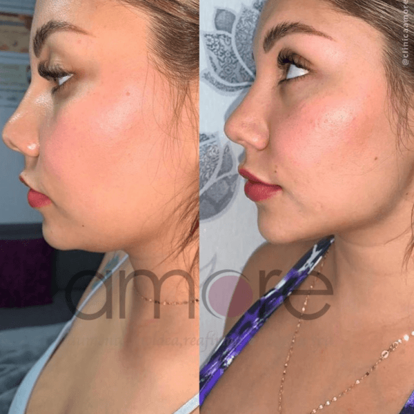 Enzimas Reductivas - 3 viales