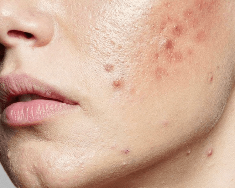 Piel Sensible con Acné