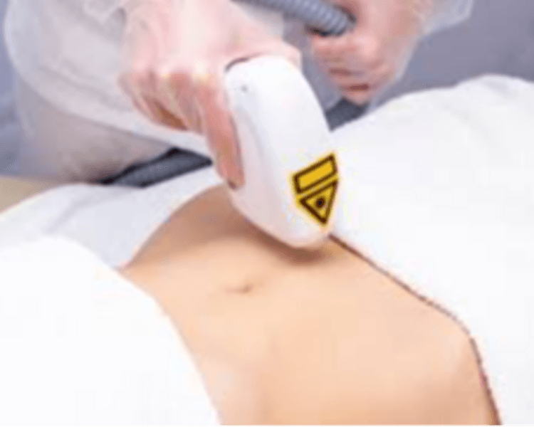 Depilación Láser Zona D (Abdomen, Cara completa, Gluteos, 1/2 Espalda, Hombros, Pecho, 1/2 Brazos)