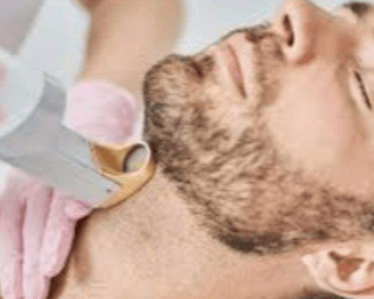 Depilación Láser Barba completa