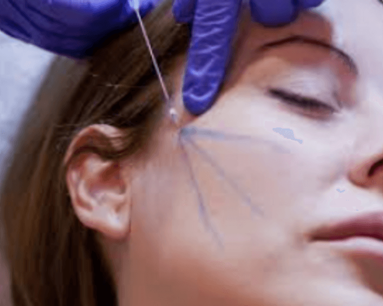 Hilos de tracción facial y corporal X zona (COSTO A EVALUAR)