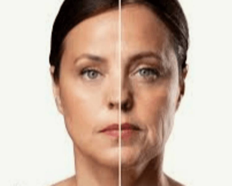 Lifting facial con radiofrecuencia (3 sesiones)