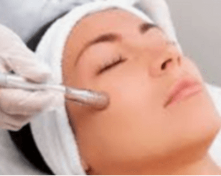 Limpieza Facial Profunda con Microdermoabrasión con Punta de Diamante
