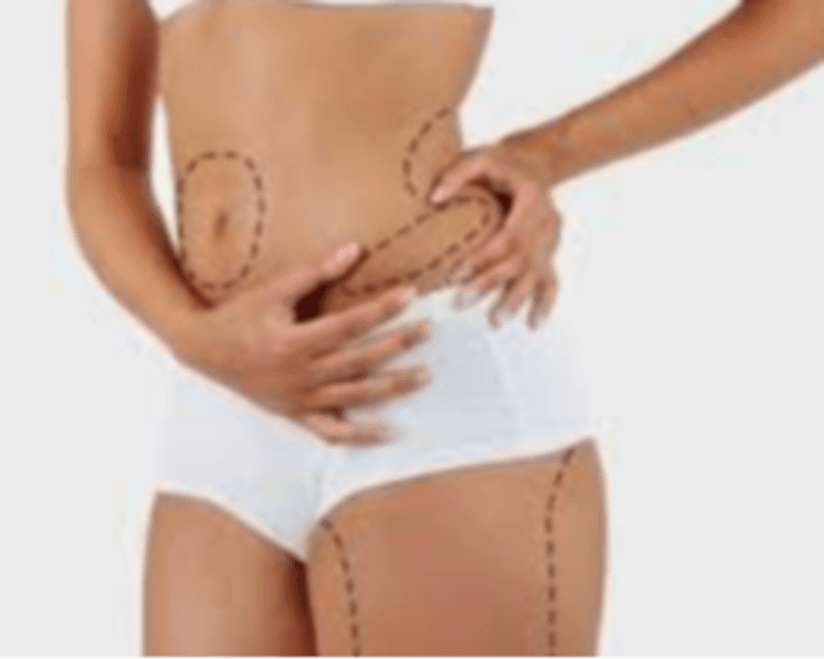 Tratamiento Lipo Sin Cirugía