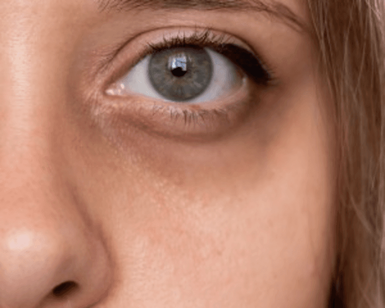 TRATAMIENTOS PARA OJERAS