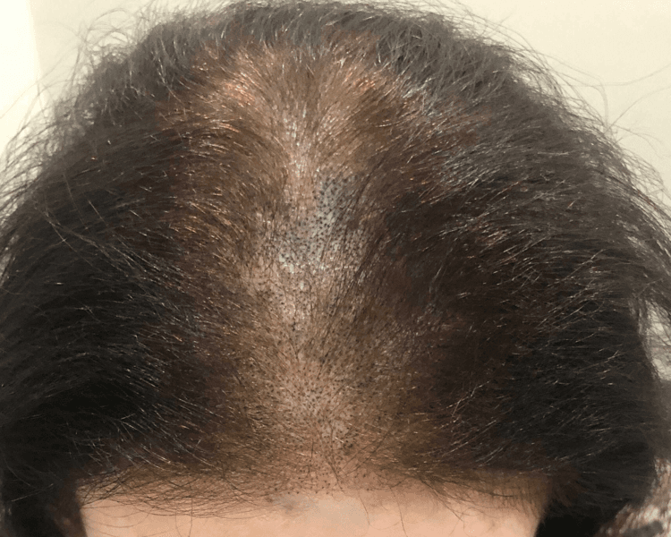 Mantenimiento anual de micropigmentación capilar