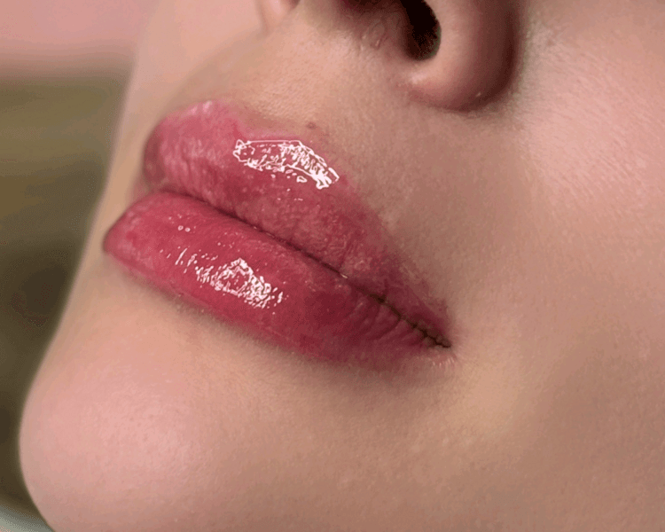 Aumento de labios con ácido hialuronico