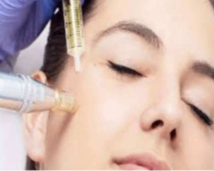 Limpieza Facial Básica + PRP (Plasma Rico en Plaquetas), 1 sesión