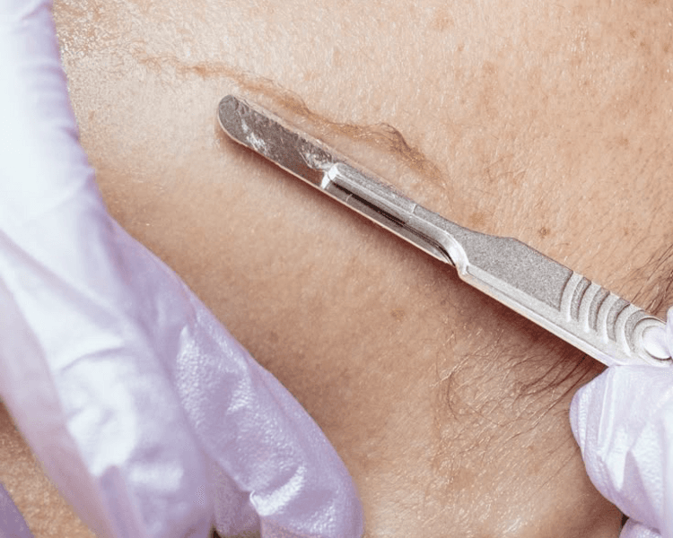 DERMAPLANING+Limpieza facial