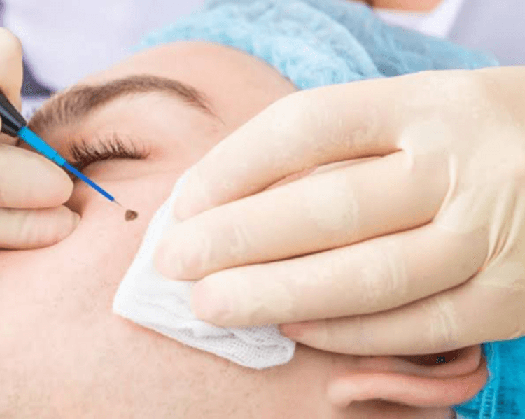 ELIMINACIÓN DE ACROCORDONES