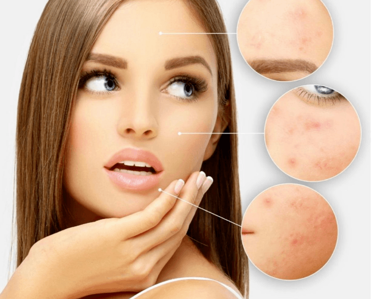 Higiene profunda facial o de cuello/escote mas peeling quimico