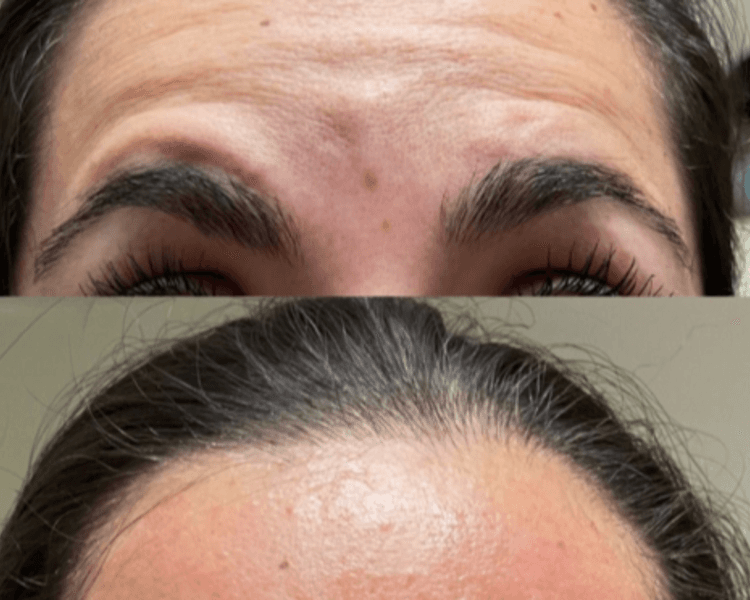 Toxina o botox 1 zona