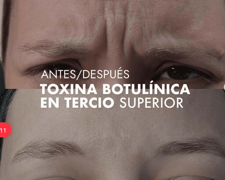 Toxina o Botox 3 zonas