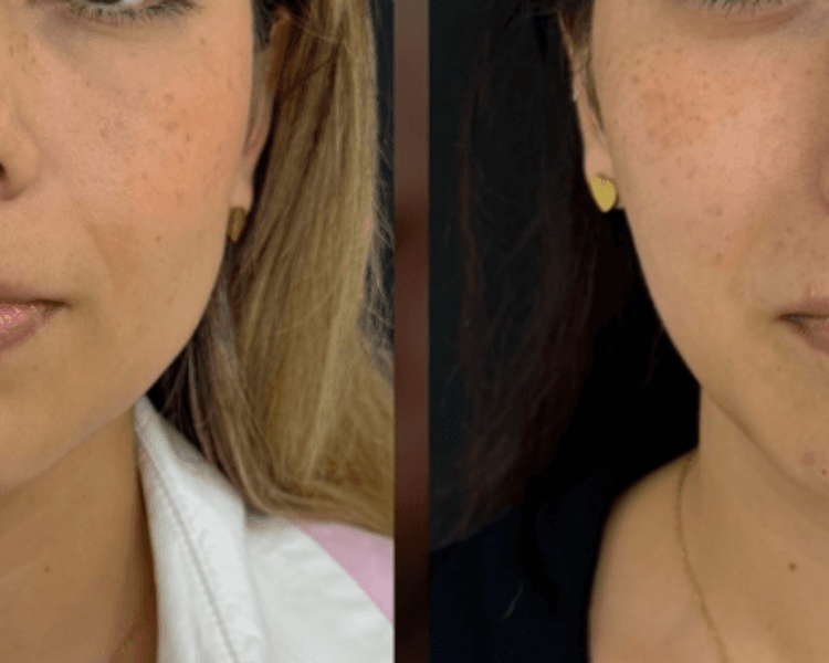 Toxina o Botox Bruxismo