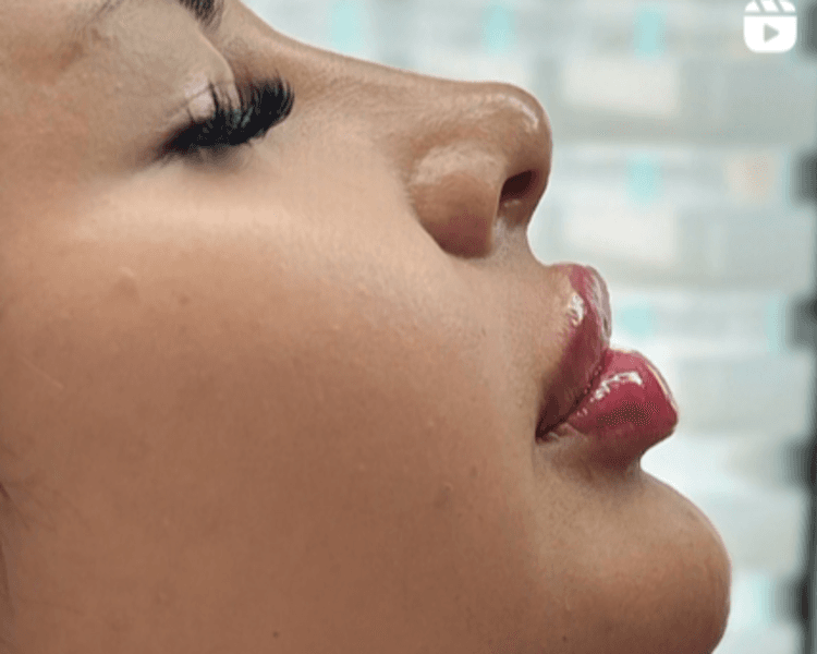 1ml Acido Hialuronico