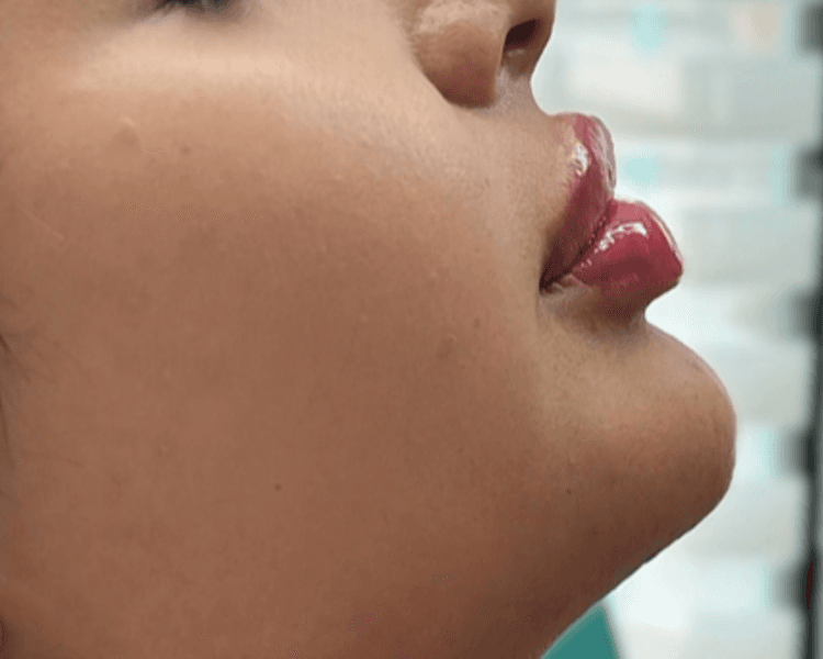 2ml Acido Hialuronico