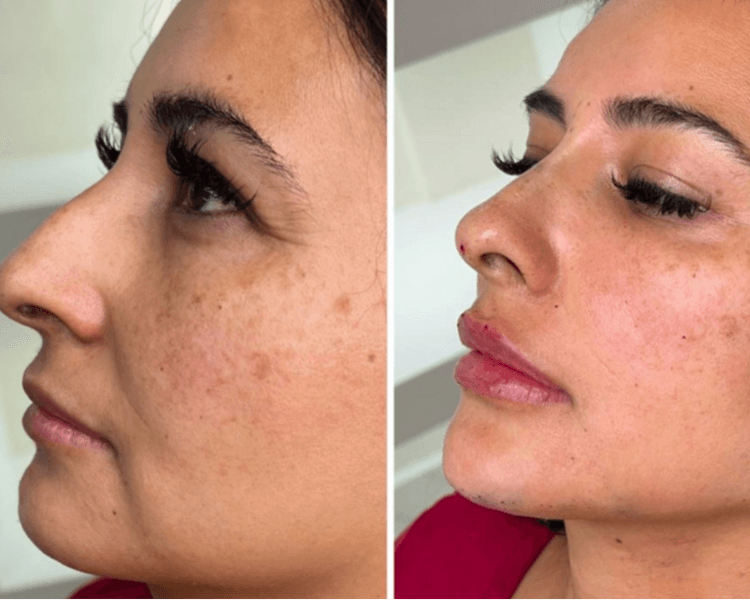 Armonización facial o Full face o Doll face