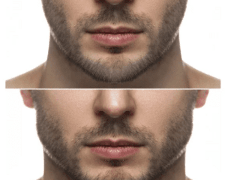 Mandíbula perfilado