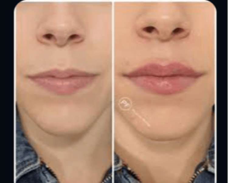 Labio Natural 1ml Acido hialuronico