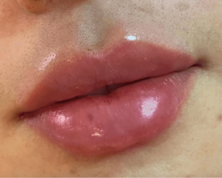 Labios Ruso o Bratz 2ml acido hialuronico