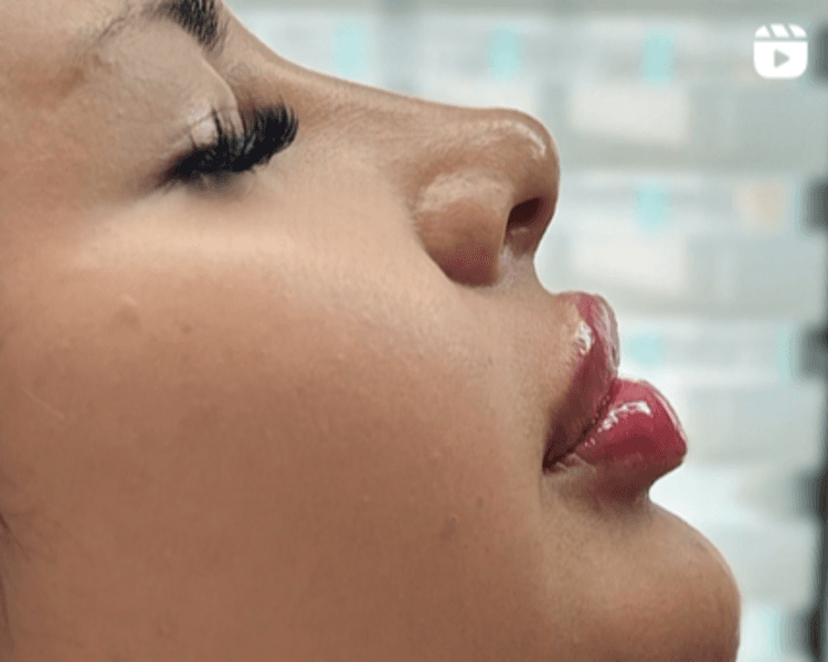 Rinomodelación PREMIUM