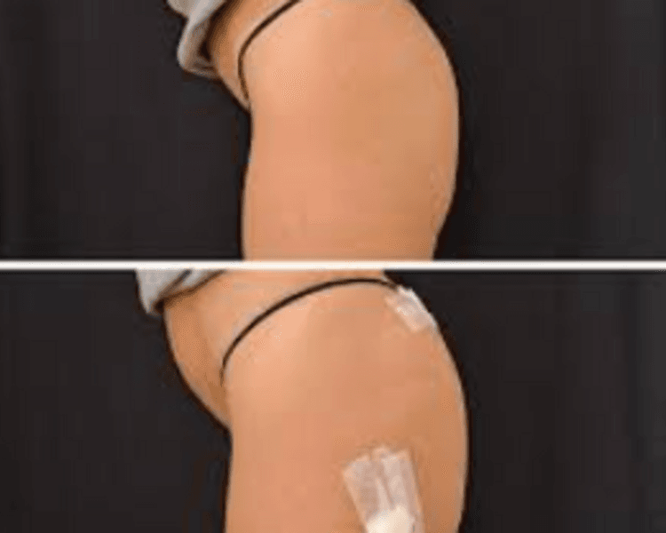 Gluteos relleno aumento Acido Hialuronico