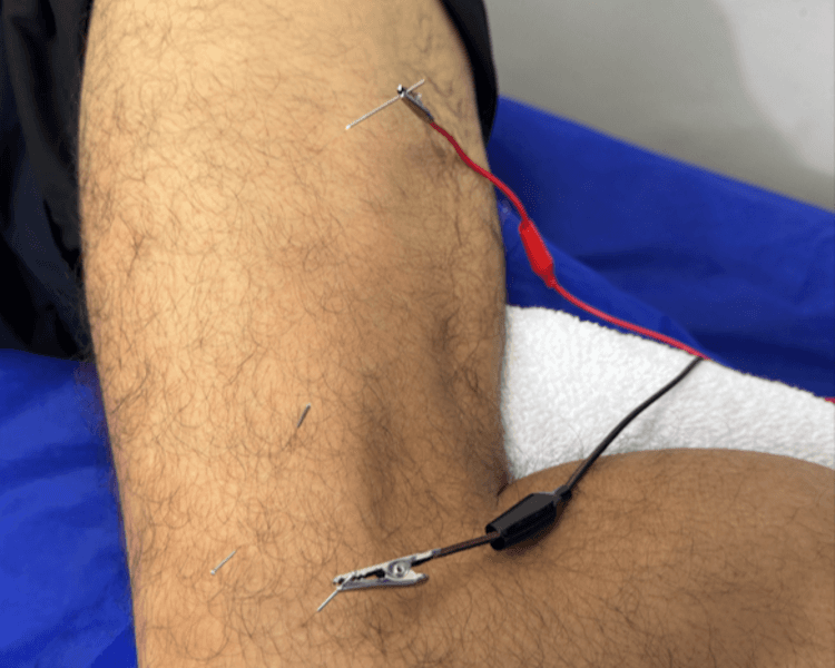 Terapia con Punción Seca