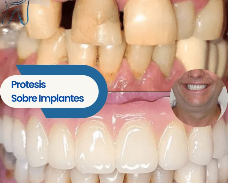 Implante Dental Unitario