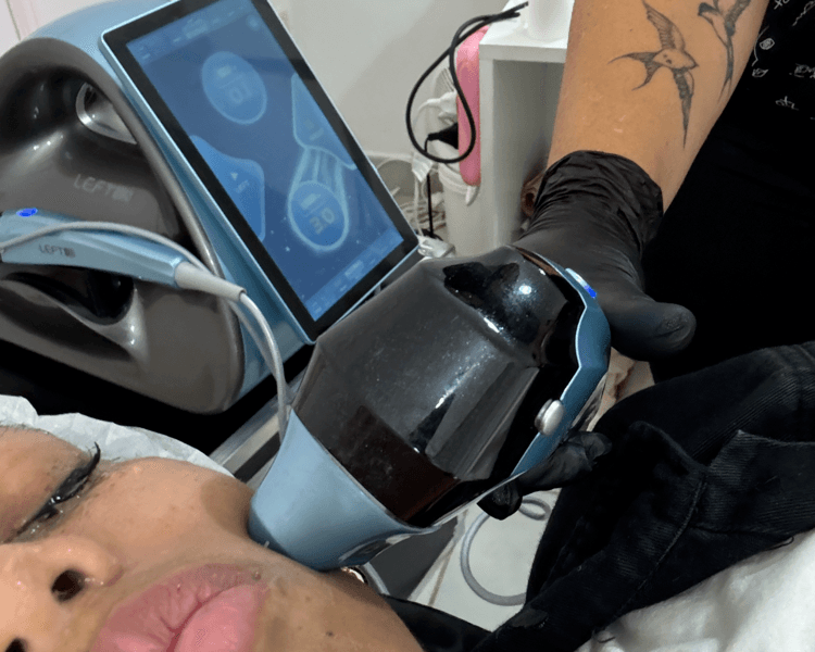 Hifu 12D Max rostro y papada