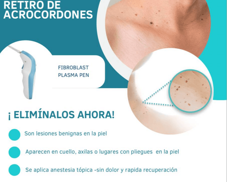 Acrocordones 01- 05
