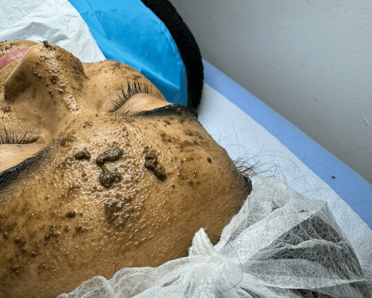 Peeling algas zena + fototerapia - Rostro