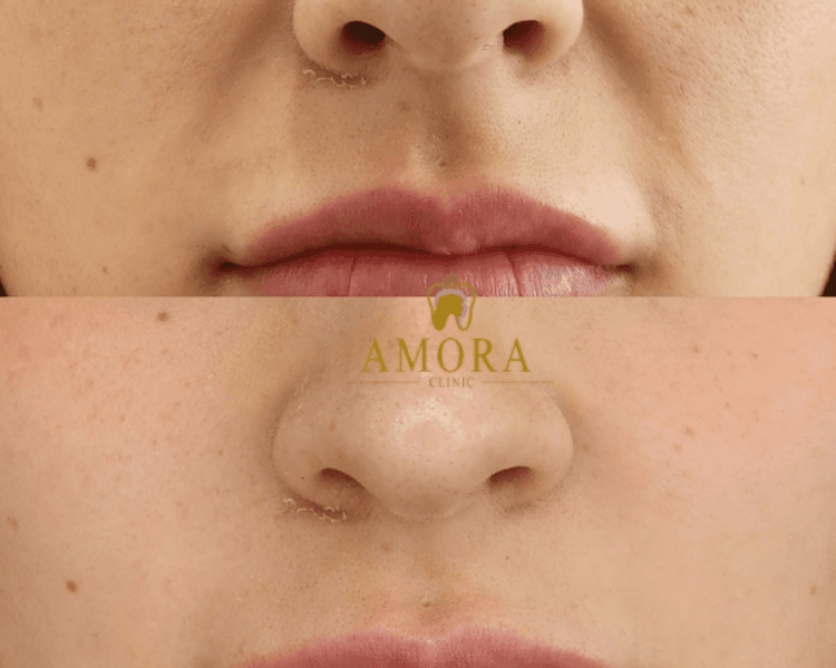 Relleno de surcos nasogenianos –$200.000 (M. Hyafilia)/ $260.000 (M. Juvederm)