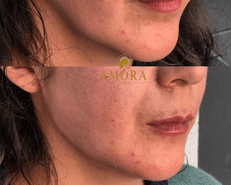 Perfilado Mandibular- $600.000 (10 ml- M. Hyafilia)