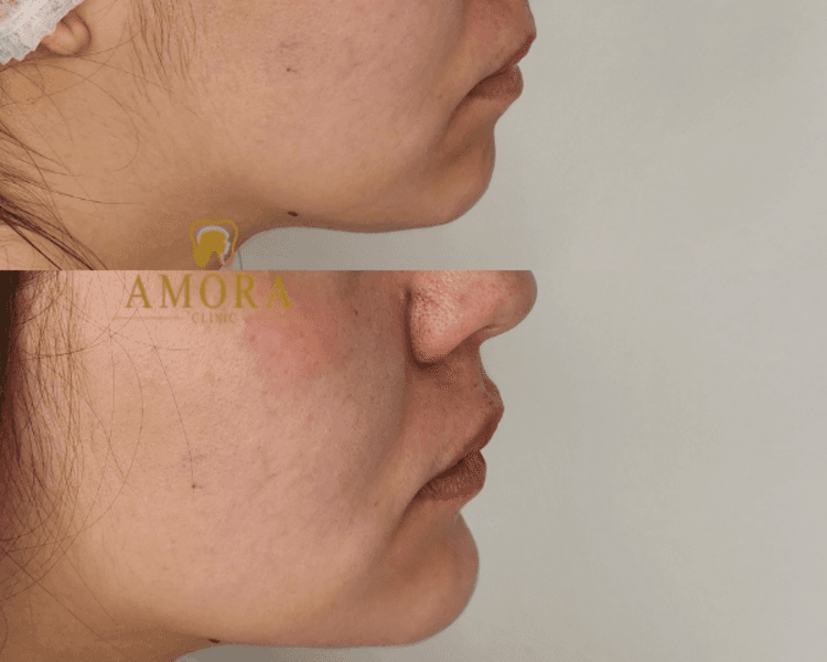 Mentomodelación– $180.000 (1 ml- M.Hyafilia) / $260.000 (1ml- M.Juvederm) / $600.000 (10 ml-M. Hyafilia)