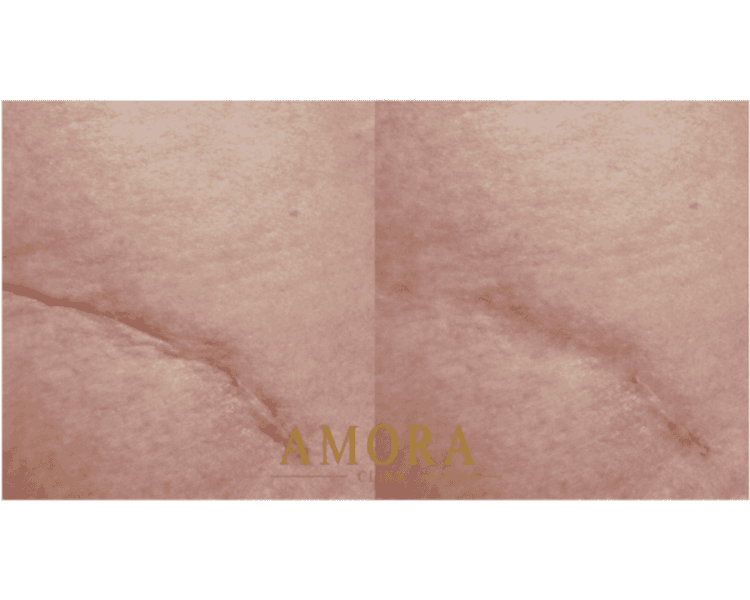 Relleno de cicatrices atróficas – $150.000 (M. Hyafilia) /$230.000 (M.Juvederm)