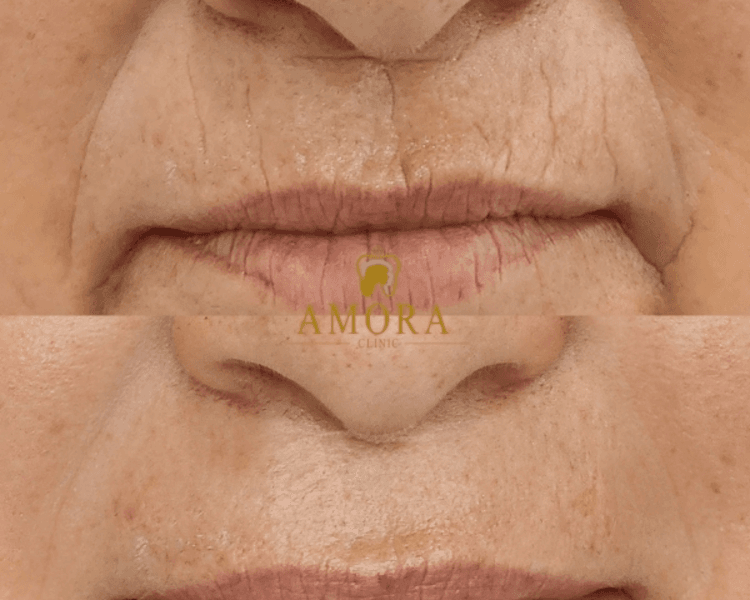 Relleno de arrugas código de barras – $216.000 (M. Viscoderm)