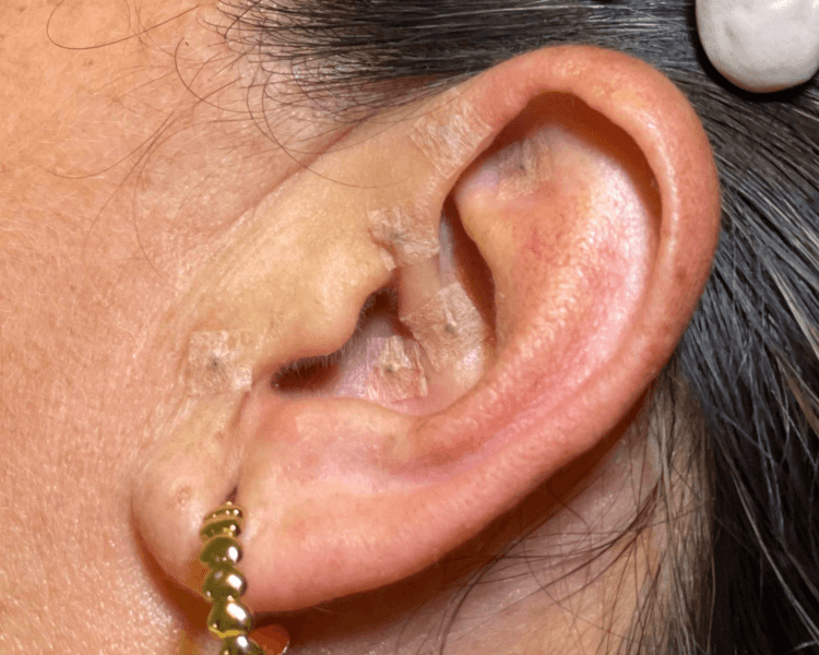 Sesión de Auriculoterapia