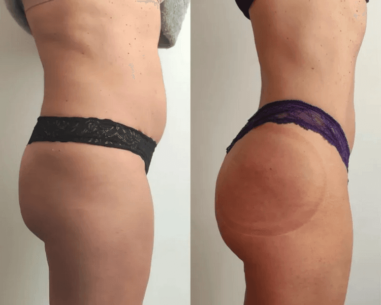 Sesión de Reposicionamiento de Glúteo