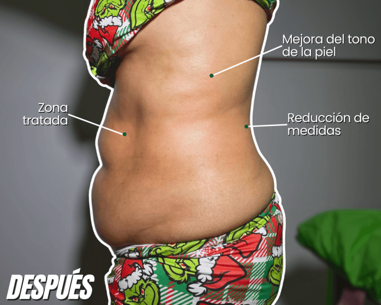 Sesión de Lipolítico + Drenaje