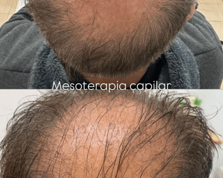 Mesoterapia Capilar