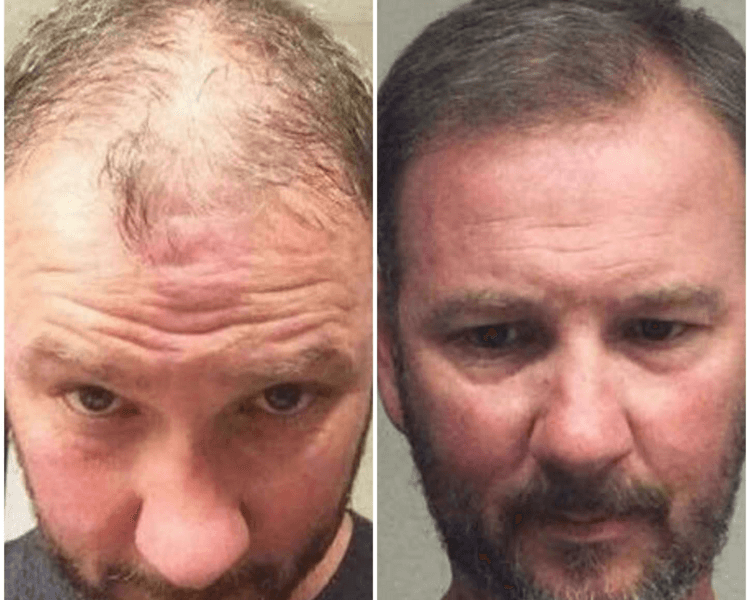 CAPILAR MESOTERAPIA POR SESIÓN PROMO