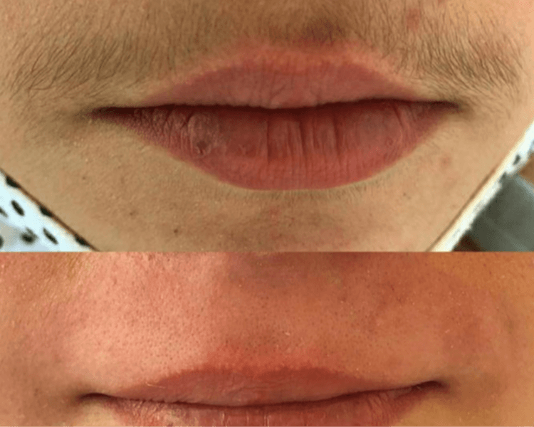 DEPILACION BOZO - PERFILADOR