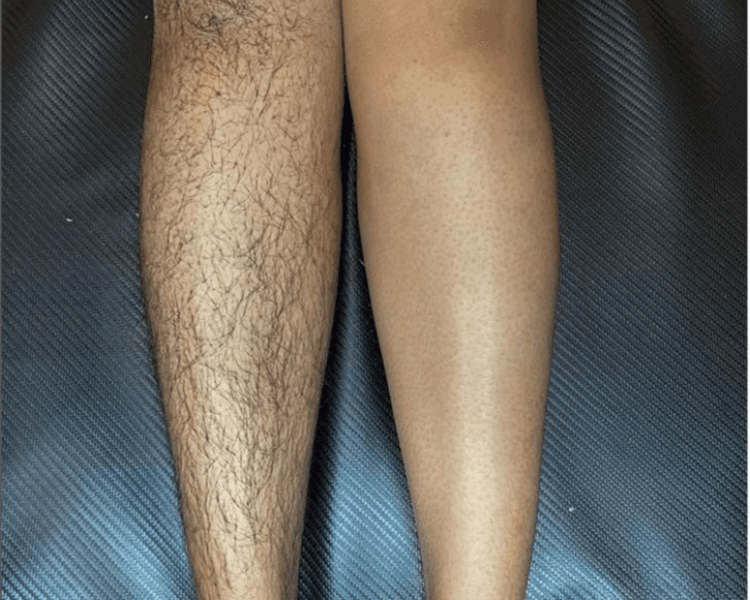 DEPILACION PIERNAS - CERA