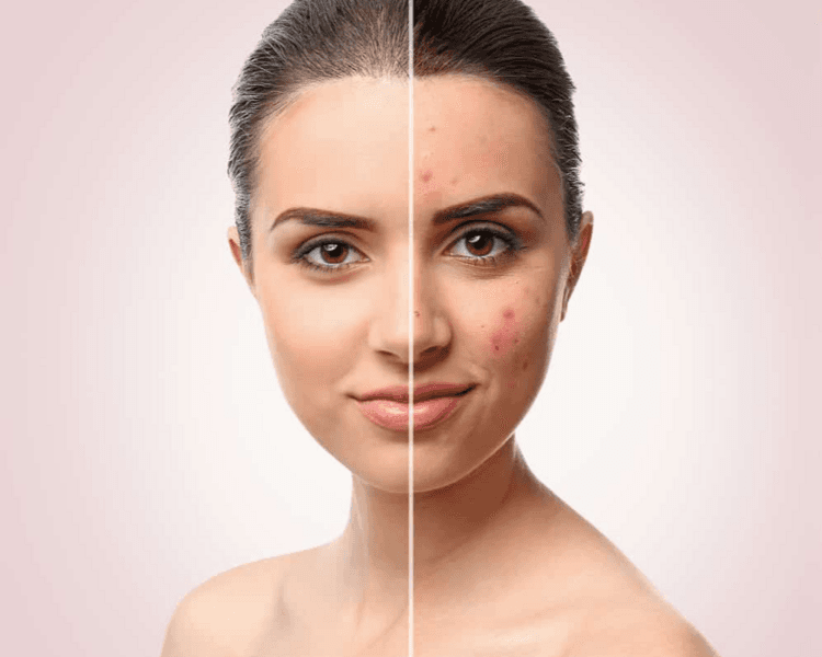 paquete de 7 tratamientos faciales contra el acné