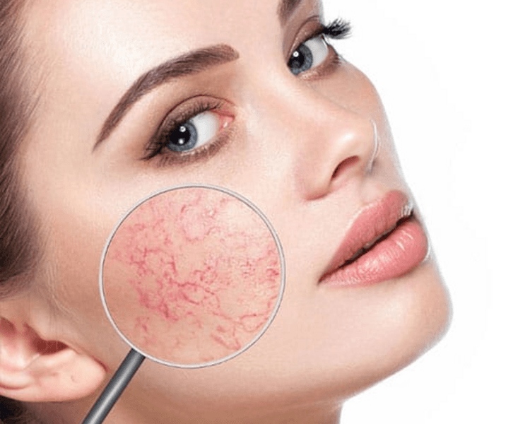 Paquete de 7 sesiones-Limpieza Facial para Piel Sensible y con Alteraciones Vasculares