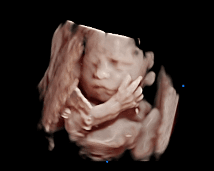 Ecografías Doppler 1er y 2do trimestre + 5D