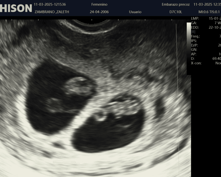 Ecografía Inicial (Se realiza antes de las 11 semanas (ante sospecha de embarazo))