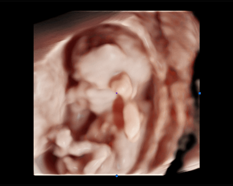 Ecografía Doppler 1er Trimestre (11-14 semanas)